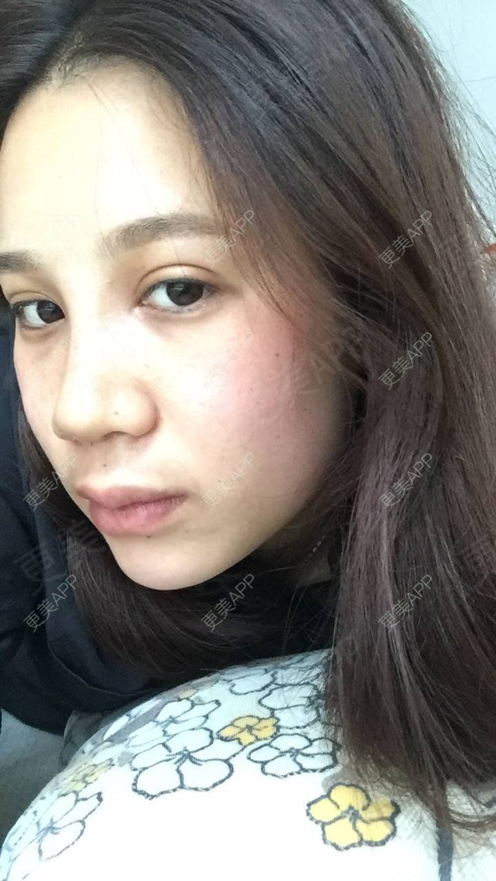 更美 - 更美用户RwtQyrji7u的鼻部多项经验 | 成都 | 鼻部多项