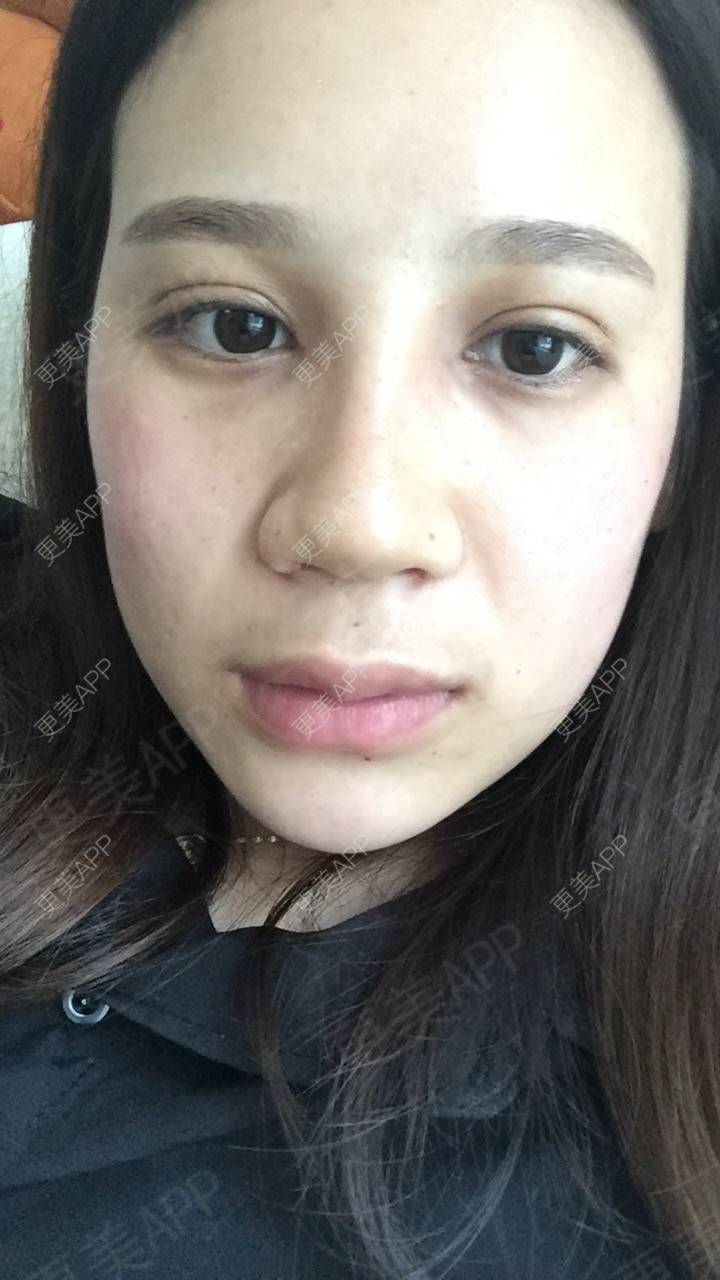 更美 - 更美用户RwtQyrji7u的鼻部多项经验 | 成都 | 鼻部多项