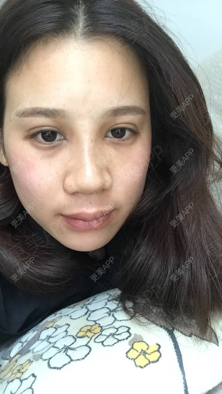 更美 - 更美用户RwtQyrji7u的鼻部多项经验 | 成都 | 鼻部多项