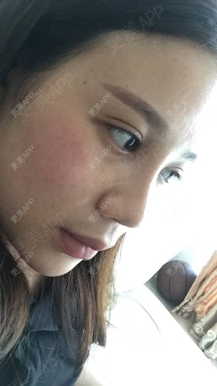 更美 - 更美用户RwtQyrji7u的鼻部多项经验 | 成都 | 鼻部多项