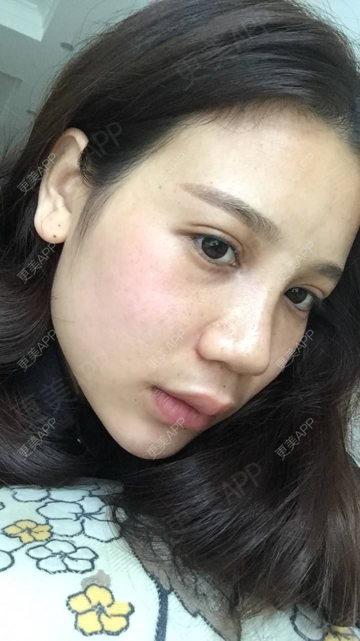 更美 - 更美用户RwtQyrji7u的鼻部多项经验 | 成都 | 鼻部多项