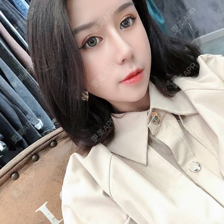 更美 - 更美用户9yYXeaKYPH的鼻部多项经验 | 鼻部多项 | 鼻中隔软骨垫鼻头 | 自体软骨垫鼻尖 | 鼻小柱缩短 | 肋软骨隆鼻