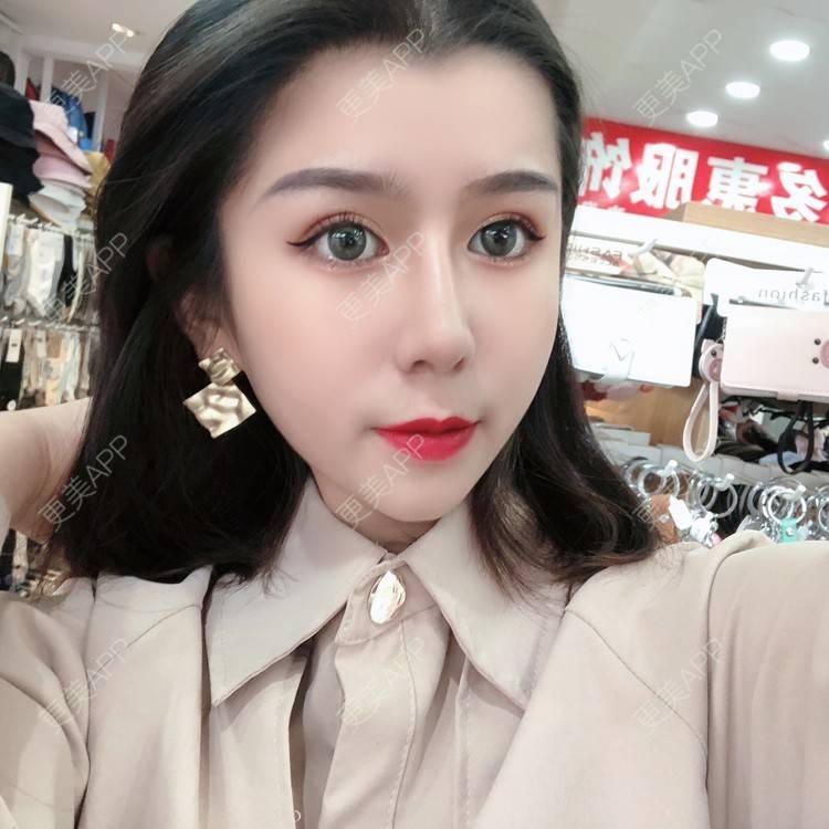 更美 - 更美用户9yYXeaKYPH的鼻部多项经验 | 鼻部多项 | 鼻中隔软骨垫鼻头 | 自体软骨垫鼻尖 | 鼻小柱缩短 | 肋软骨隆鼻