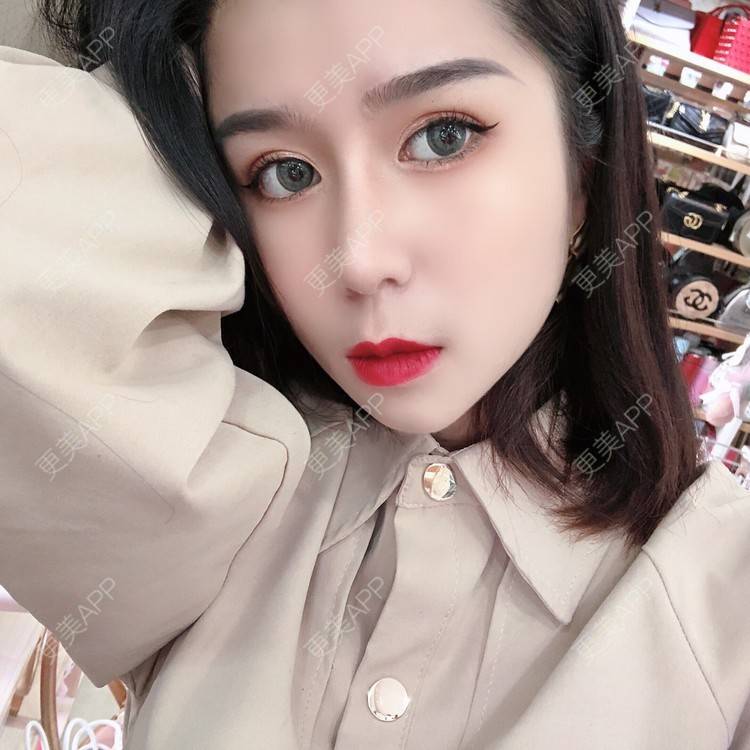 更美 - 更美用户9yYXeaKYPH的鼻部多项经验 | 鼻部多项 | 鼻中隔软骨垫鼻头 | 自体软骨垫鼻尖 | 鼻小柱缩短 | 肋软骨隆鼻