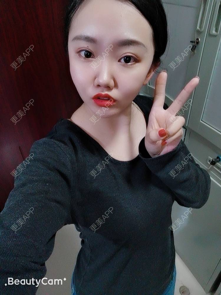 更美 - 萌萌哒淡墨的经验 | 腰腹吸脂 | 背部吸脂 | 自体脂肪丰臀 | 手臂吸脂 | 成都 | 视频日记