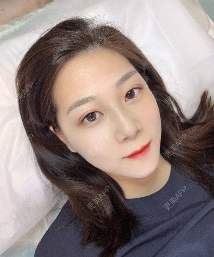 更美 - 更美用户2wy7vU5zUb的半永久纹发际线经验 | 北京 | 半永久纹发际线