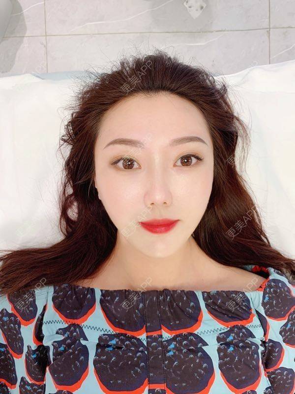 更美 - 更美用户CHMLndYWSa的半永久纹发际线经验 | 北京 | 半永久纹发际线