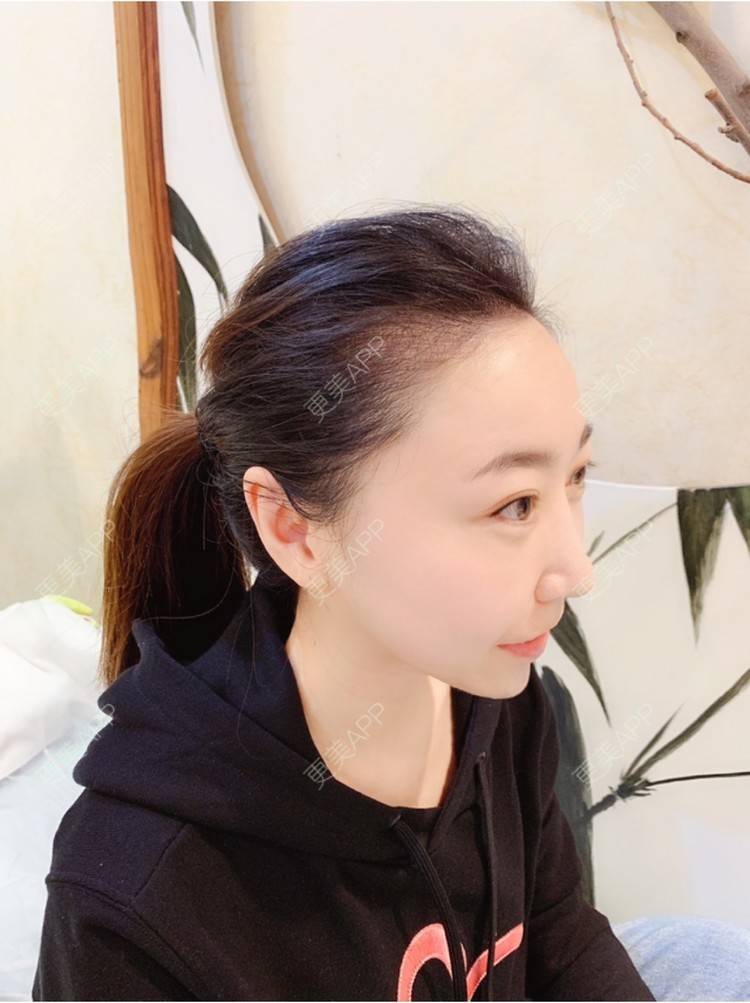 更美 - 更美用户jAs0SgIsLt的半永久纹发际线经验 | 北京 | 半永久纹发际线