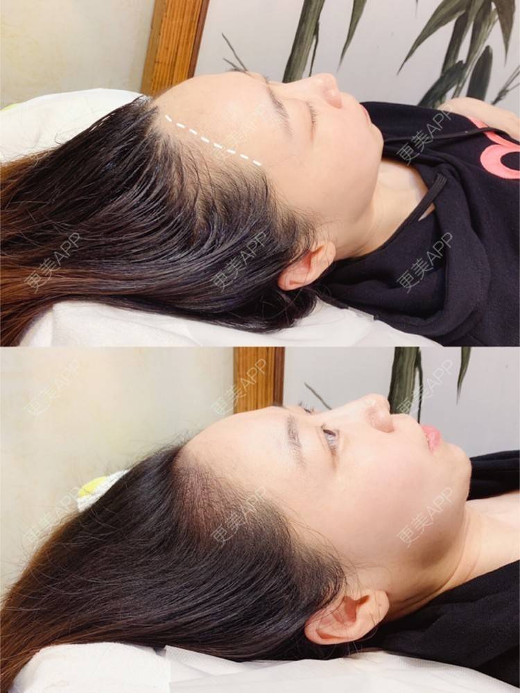 更美 - 更美用户jAs0SgIsLt的半永久纹发际线经验 | 北京 | 半永久纹发际线