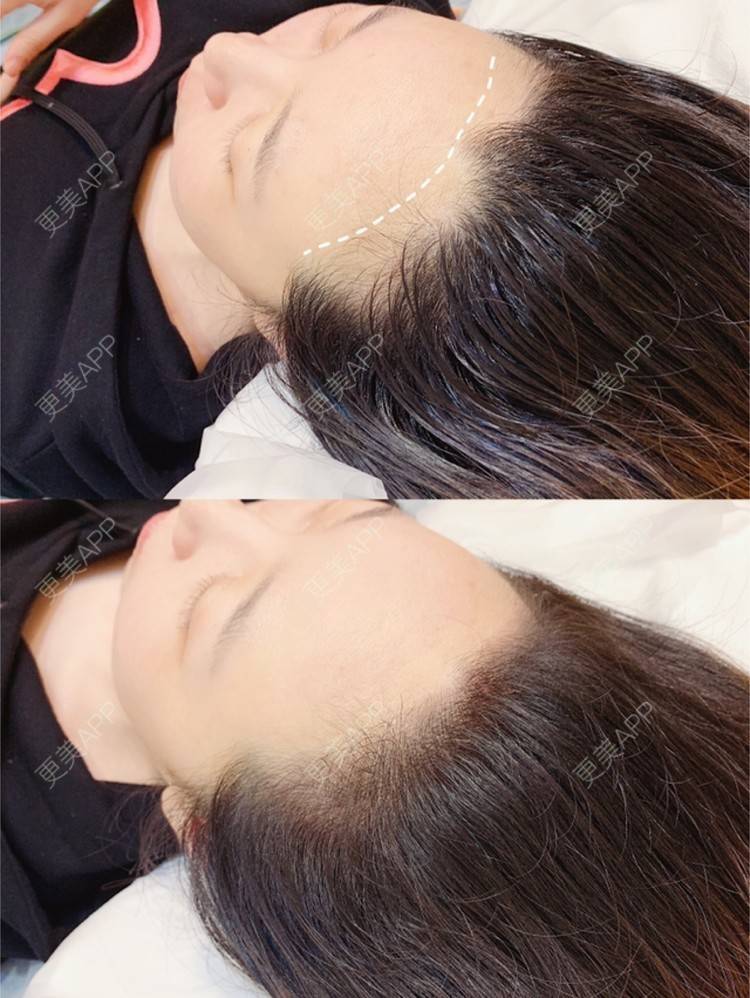 更美 - 更美用户jAs0SgIsLt的半永久纹发际线经验 | 北京 | 半永久纹发际线