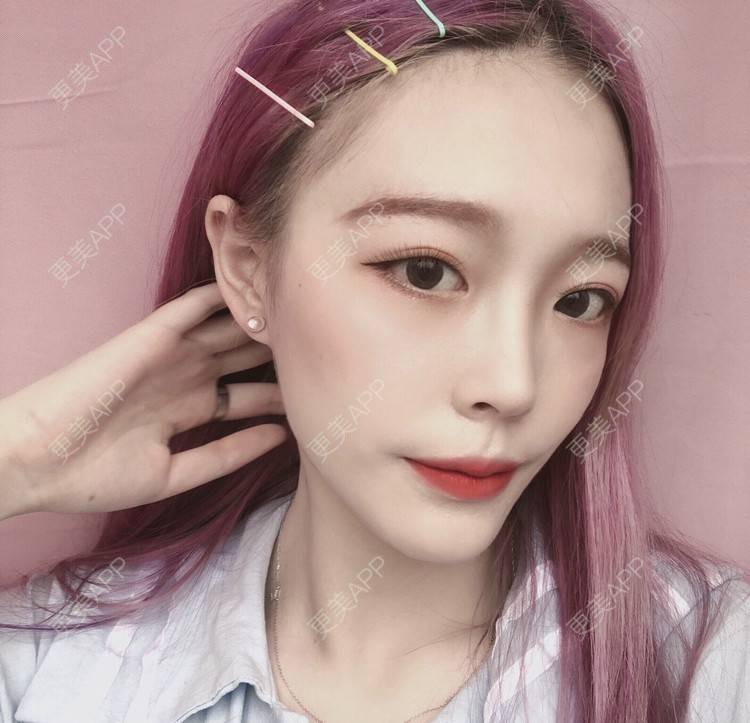 更美 - 冷语热心人的手术去副乳经验 | 手术去副乳 | 上海