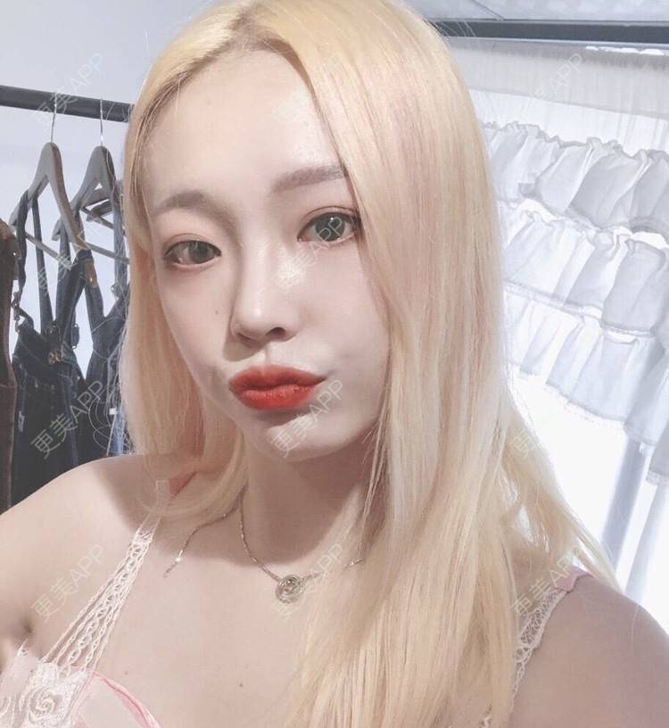 更美 - 冷语热心人的手术去副乳经验 | 手术去副乳 | 上海