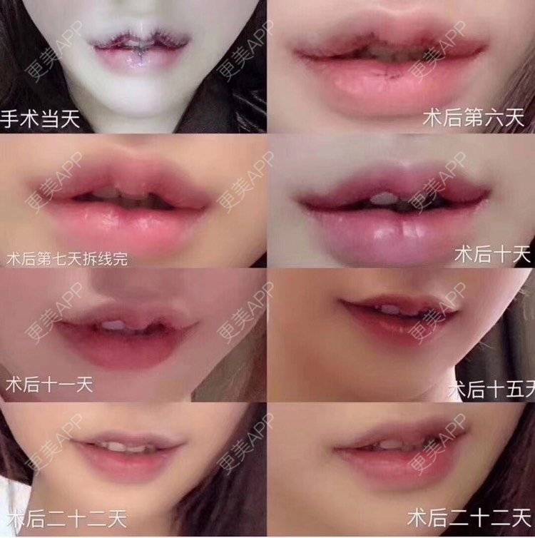 更美 - 祢的美丽/我的职责的M唇成形经验 | M唇成形 | 上海