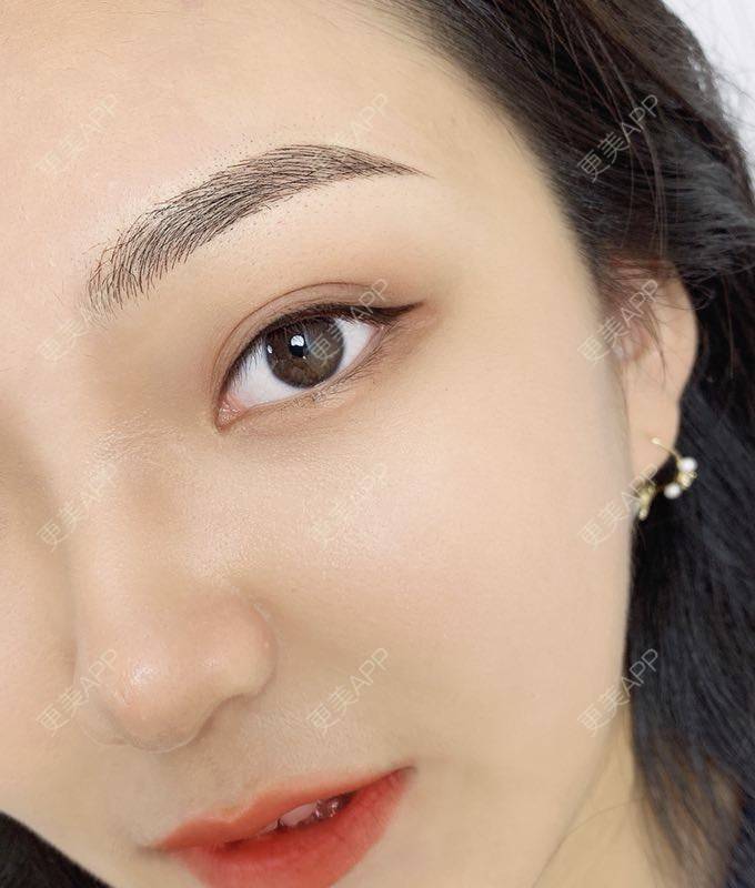 更美 - 更美用户DUrTv1xXun的半永久纹发际线经验 | 北京 | 半永久纹发际线