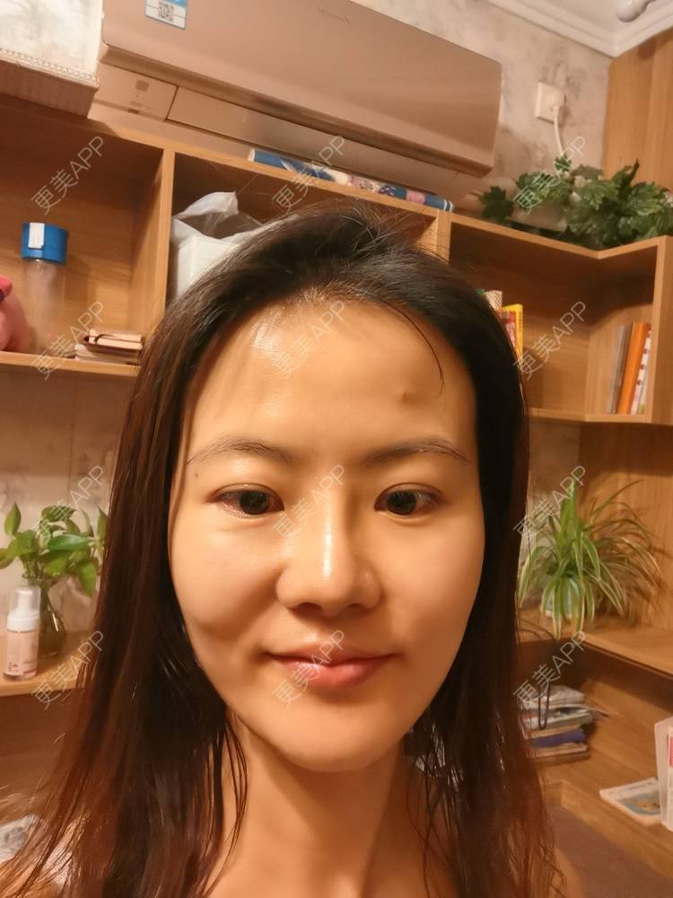 更美 - umgsd的植发际线经验 | 植发际线 | 上海