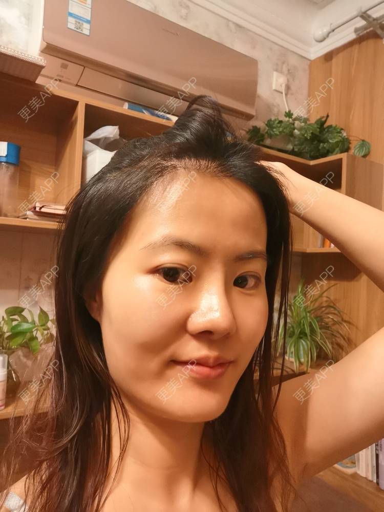 更美 - umgsd的植发际线经验 | 植发际线 | 上海