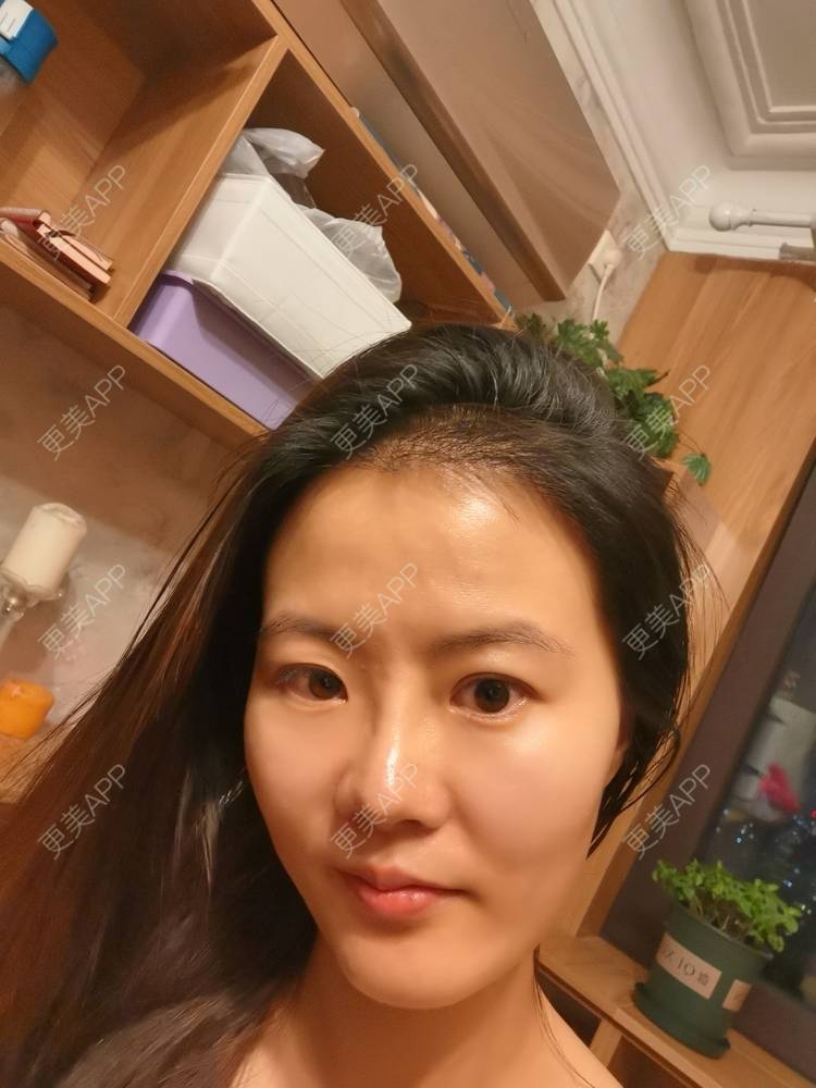 更美 - umgsd的植发际线经验 | 植发际线 | 上海