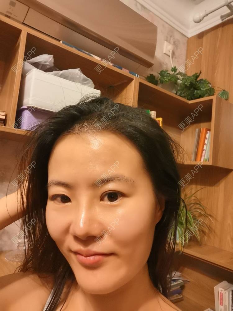 更美 - umgsd的植发际线经验 | 植发际线 | 上海