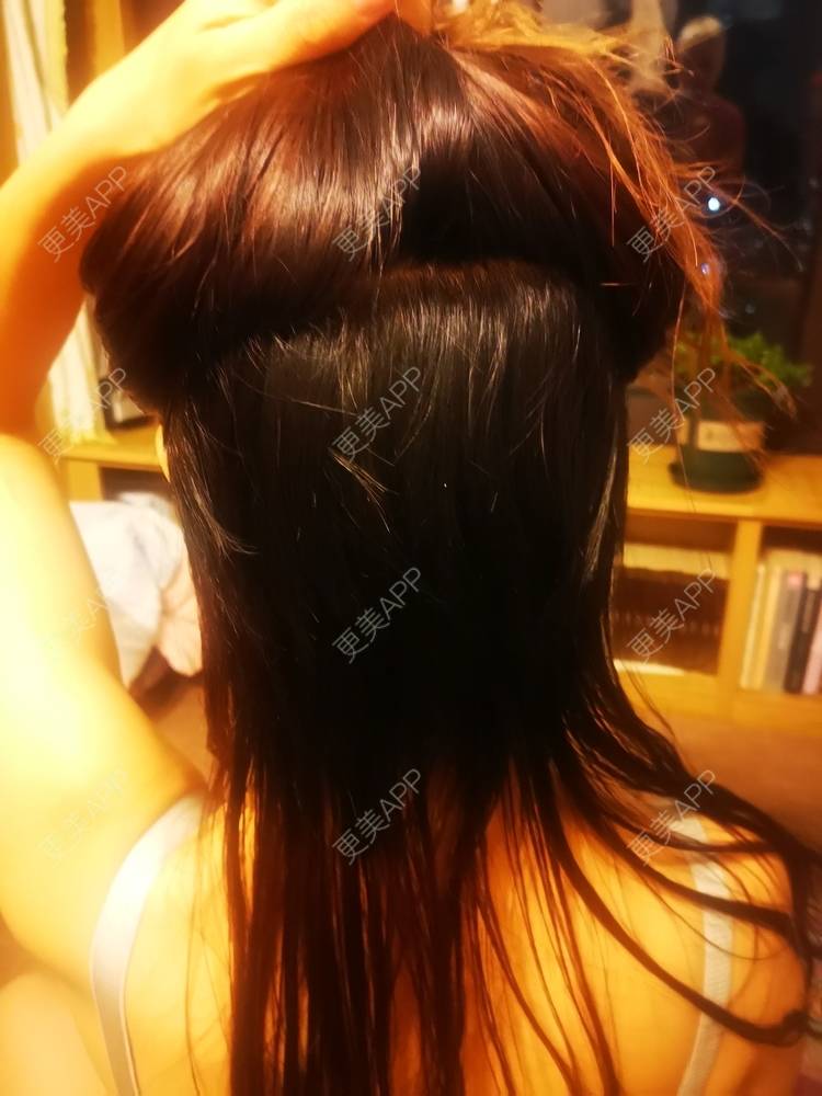 更美 - umgsd的植发际线经验 | 植发际线 | 上海