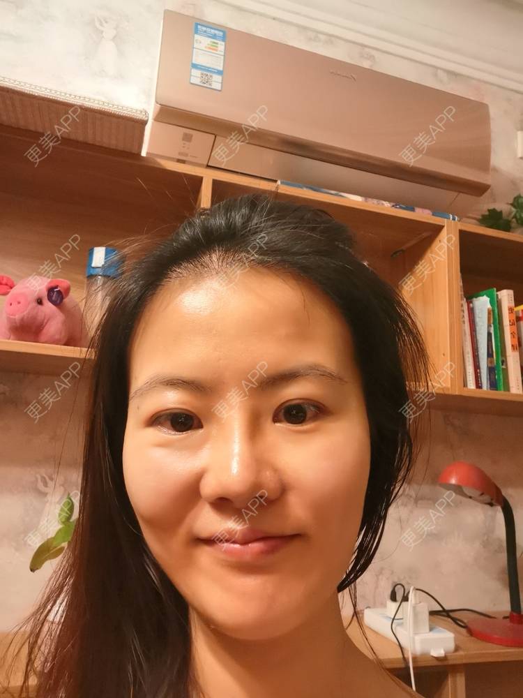 更美 - umgsd的植发际线经验 | 植发际线 | 上海