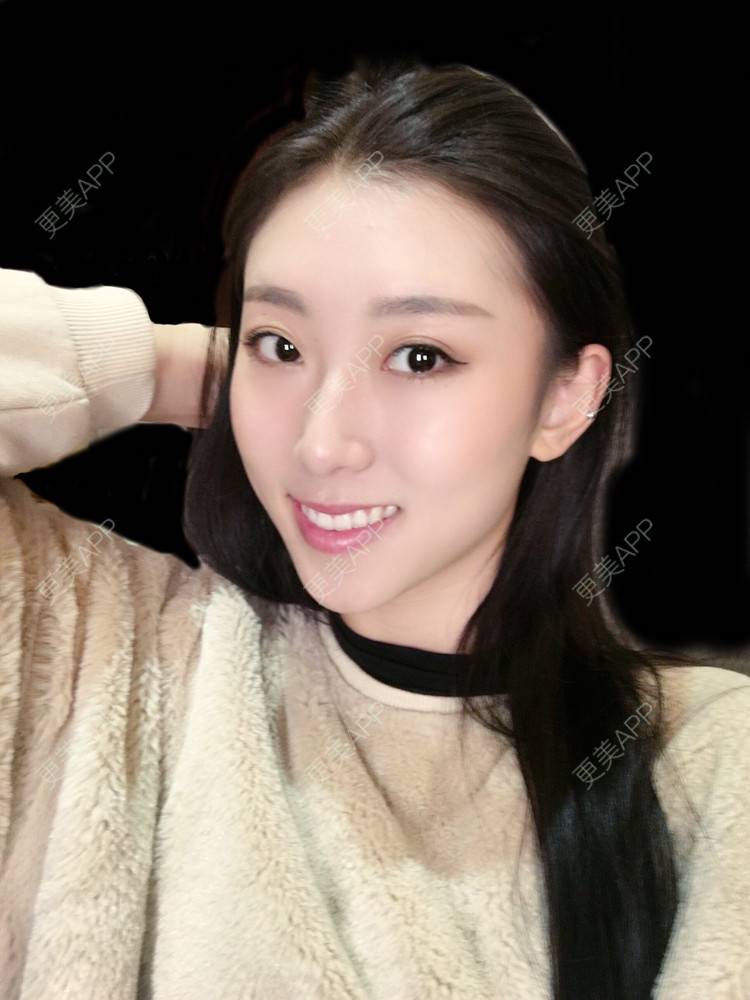 更美 - 李桥莲 医生的鼻翼缩小经验 | 视频日记 | 鼻翼缩小 | 泉州