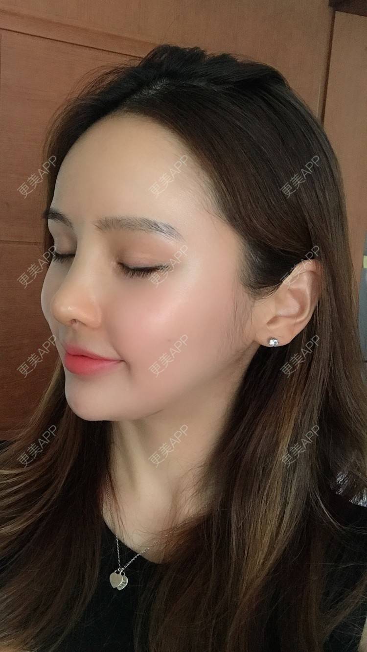 更美用户wrnolsjf3d的硅胶隆鼻日记