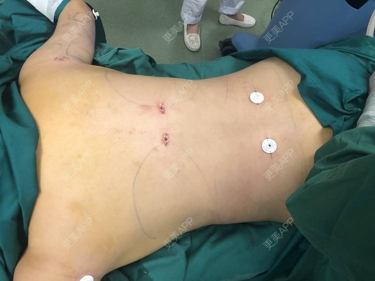 更美用户xonutref0y的背部吸脂日记