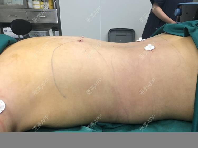 更美用户xonutref0y的背部吸脂日记