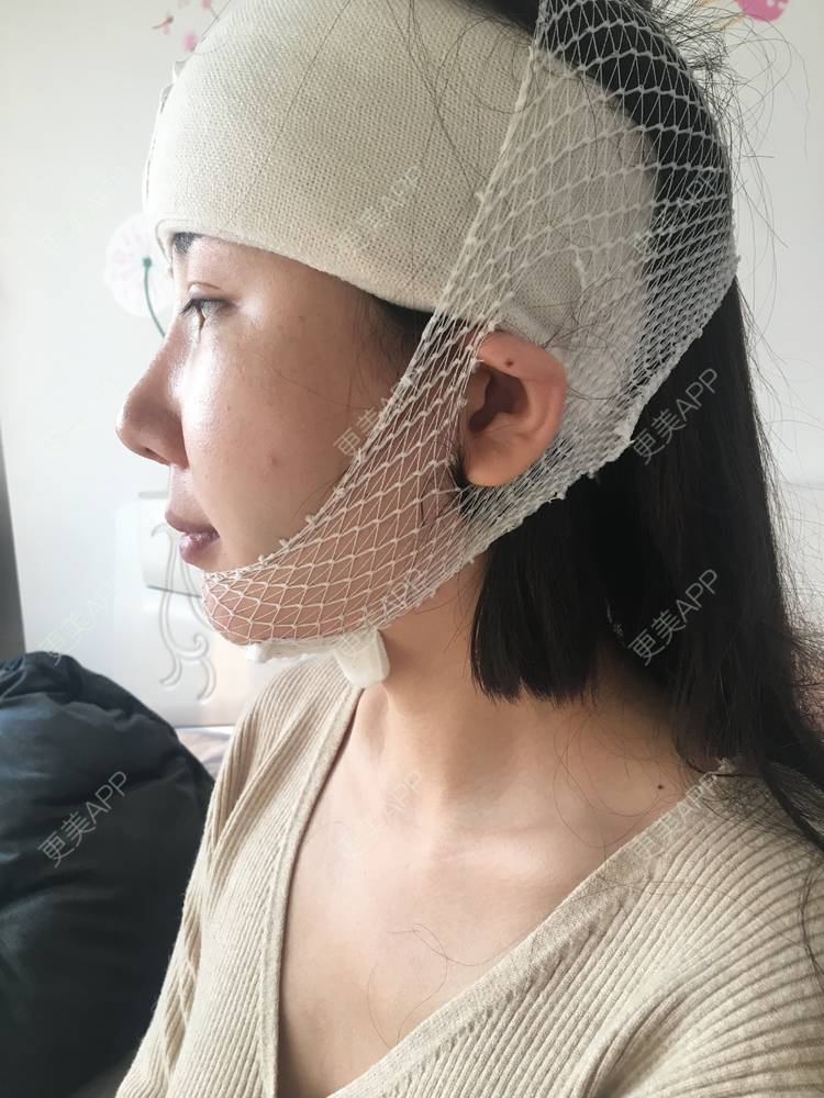 更美 - 更美用户Oq3dIHx1xG的硅胶丰额头经验 | 额头 | 硅胶丰额头 | 武汉