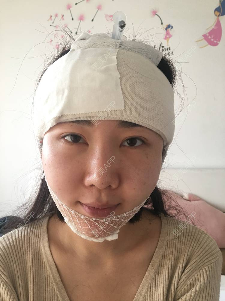 更美 - 更美用户Oq3dIHx1xG的硅胶丰额头经验 | 额头 | 硅胶丰额头 | 武汉
