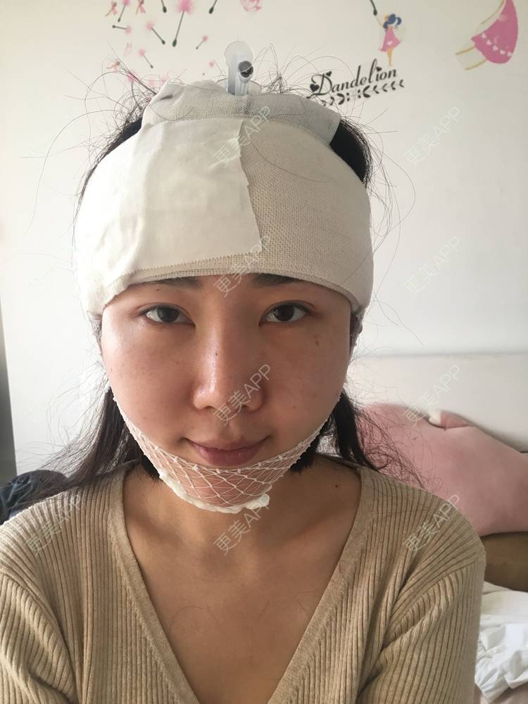 更美 - 更美用户Oq3dIHx1xG的硅胶丰额头经验 | 额头 | 硅胶丰额头 | 武汉