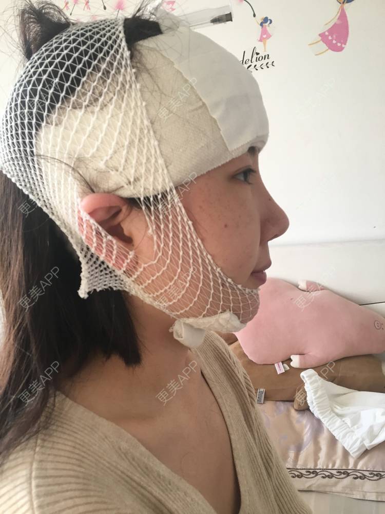 更美 - 更美用户Oq3dIHx1xG的硅胶丰额头经验 | 额头 | 硅胶丰额头 | 武汉