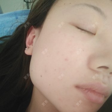 下颌角切除
