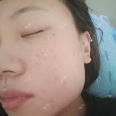 下颌角切除