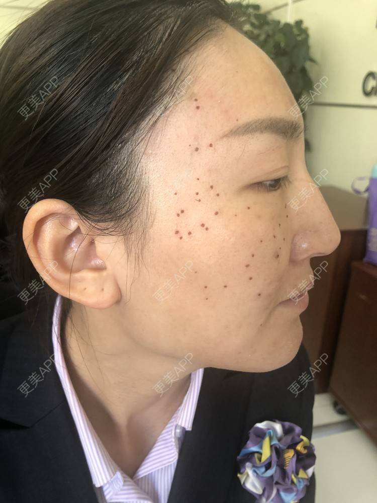 更美 - 更美用户loJGCGI72w的胶原蛋白丰泪沟经验 | 激光去脂肪粒 | 皮秒激光 | 胶原蛋白丰泪沟 | 淡化皱纹