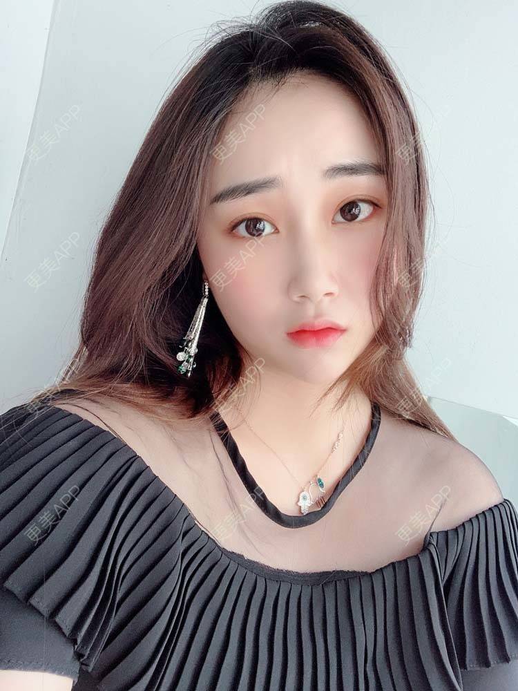 更美 - 更美用户Aj86YxCPkz的埋线除皱经验 | 埋线除皱
