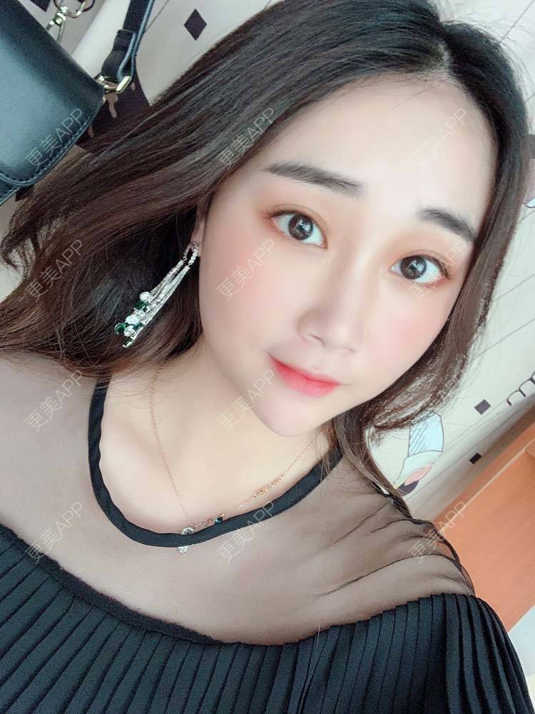 更美 - 更美用户Aj86YxCPkz的埋线除皱经验 | 埋线除皱
