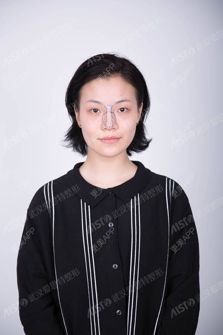更美 - 依依不舍2019的朝天鼻矫正经验 | 玻尿酸鼻部 | 肋软骨隆鼻 | 鼻中隔软骨隆鼻 | 朝天鼻矫正 | 武汉