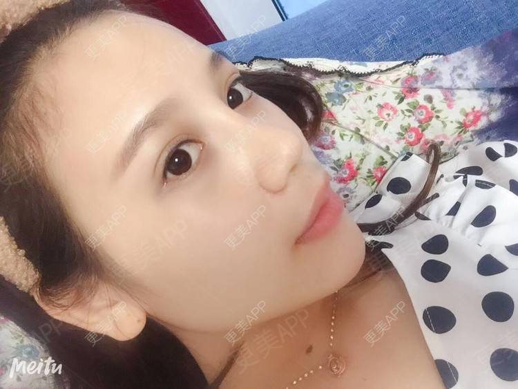 更美 - 更美用户RwtQyrji7u的鼻部多项经验 | 成都 | 鼻部多项