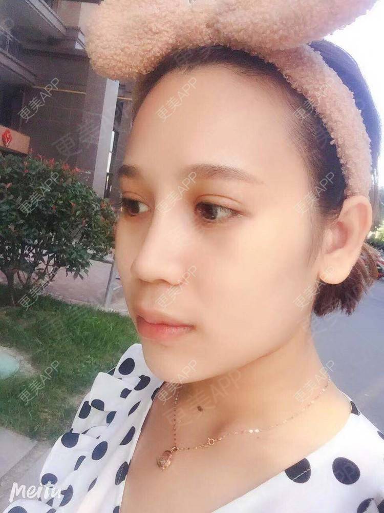 更美 - 更美用户RwtQyrji7u的鼻部多项经验 | 成都 | 鼻部多项