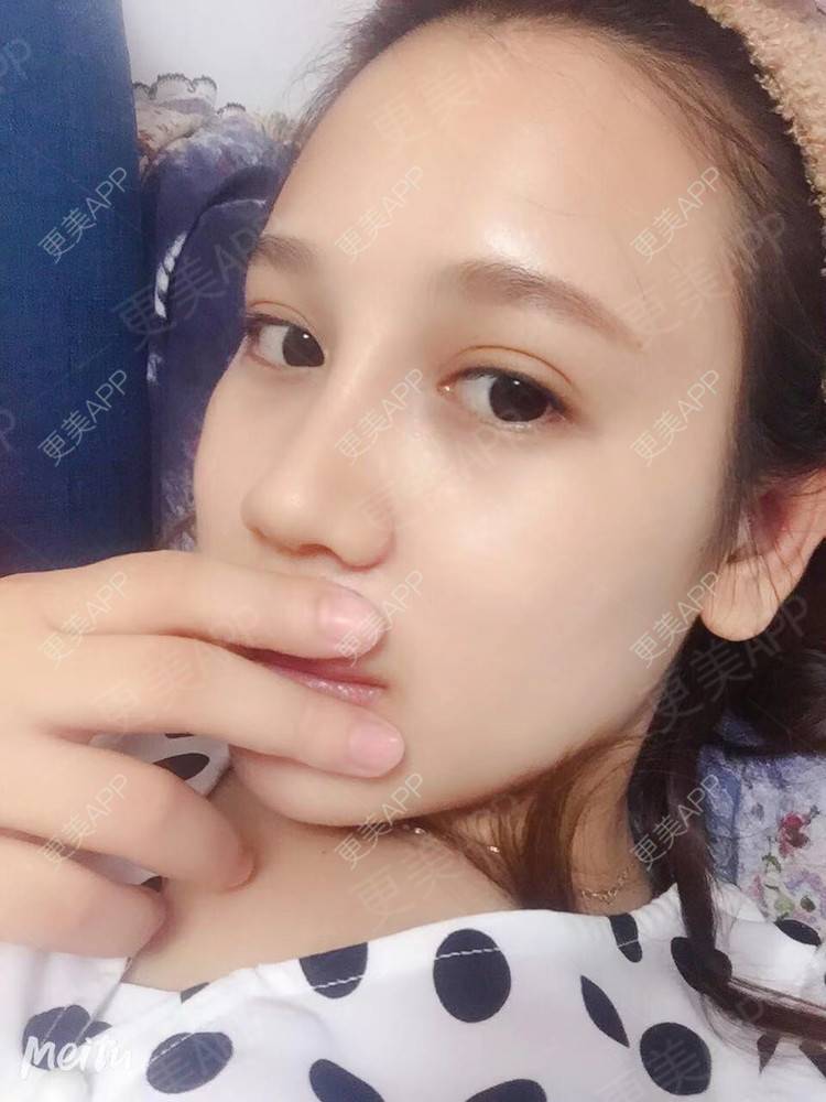 更美 - 更美用户RwtQyrji7u的鼻部多项经验 | 成都 | 鼻部多项