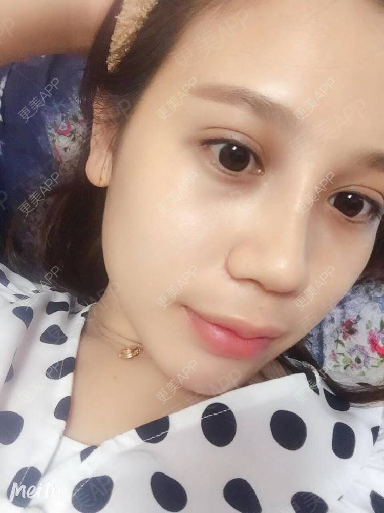 更美 - 更美用户RwtQyrji7u的鼻部多项经验 | 成都 | 鼻部多项