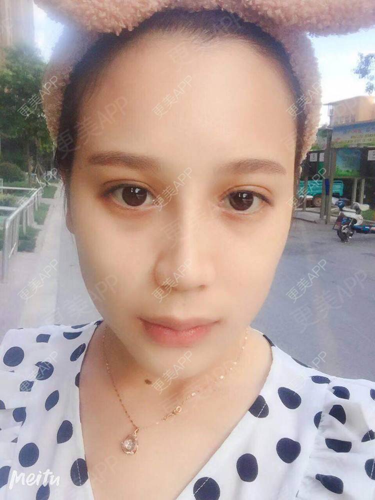 更美 - 更美用户RwtQyrji7u的鼻部多项经验 | 成都 | 鼻部多项