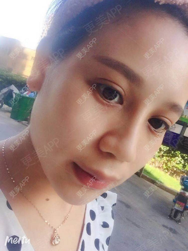 更美 - 更美用户RwtQyrji7u的鼻部多项经验 | 成都 | 鼻部多项