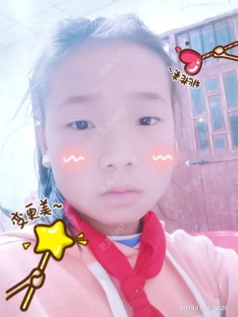 更美 - 艾丽纱的全切双眼皮经验 | 美白套餐 | 光子嫩肤 | 白瓷娃娃 | 全切双眼皮 | 腰腹吸脂 | 贵阳