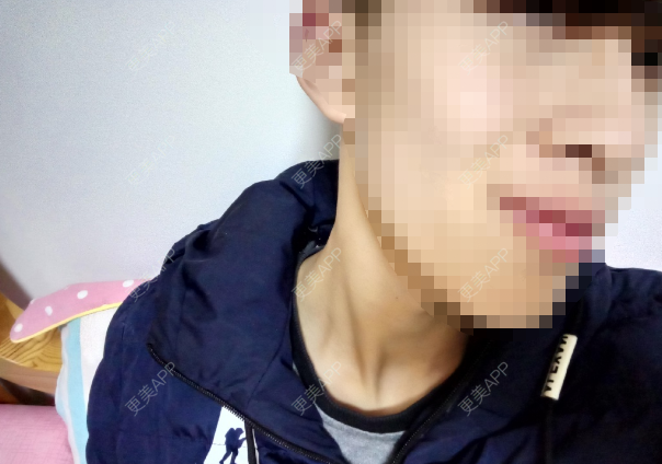 更美 - 更美用户v2nNBvjV7T的手术除腋臭经验 | 手术除腋臭 | 重庆