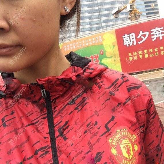 更美 - 更美用户XICrnXrqmU的祛斑祛色素经验 | 祛斑祛色素 | 激光淡斑 | 皮秒激光 | 淡斑套餐 | 台州