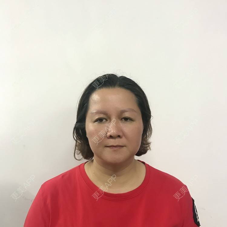 更美 - 更美用户pD6atmM6mC的切眉经验 | 深圳 | 切眉