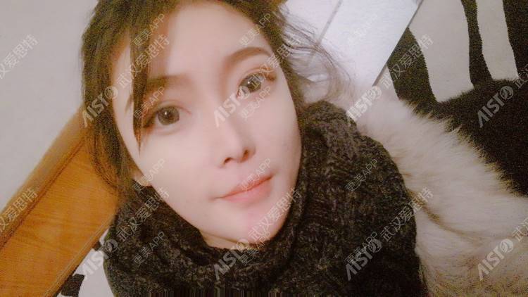 芮芮的少女时代的鼻中隔软骨隆鼻