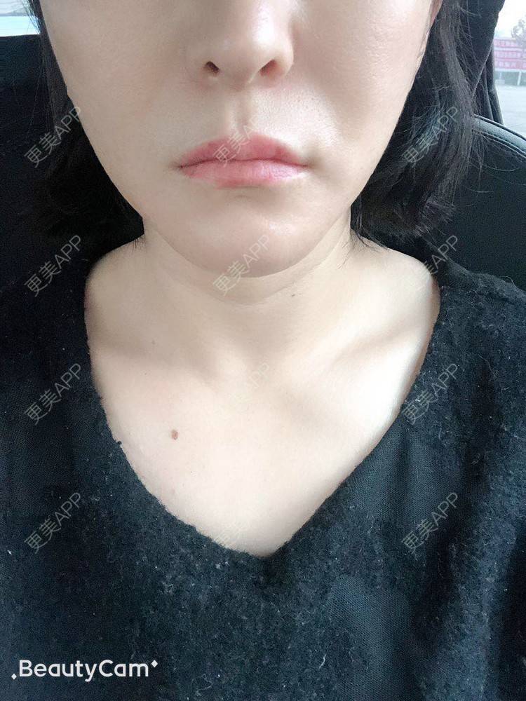 更美 - 💃🏻💕JING今的厚唇改薄经验 | 厚唇改薄 | 深圳